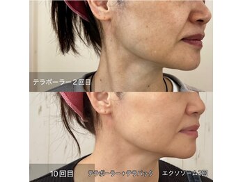 リアプア(Li'a)/くすみ肌から褒められ肌へ