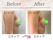 エムエムエム 表参道Luxeサロン(M.M.M)/【バストアップ例】　C→Eカップ