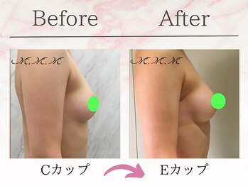 エムエムエム 表参道Luxeサロン(M.M.M)/【バストアップ例】　C→Eカップ