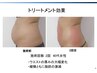 脂肪冷却【1カップ】＋ショックプレッシャー付　7,700円