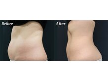 ブリエル(BRILLER)/脂肪冷却（お腹＆腰）