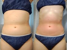 ティアス(t-us)/【痩身】ラジオ波痩身コース