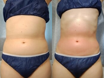 ティアス(t-us)/【痩身】ラジオ波痩身コース