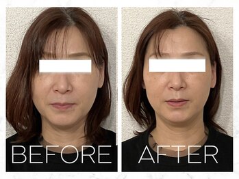 コノハナ(conohana)/頬の位置も上がりスッキリ!