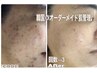 発光ベビー♪肌管理★韓国ピール×水滴トリプルLDM×MTSエレポ★カボチャPDRN