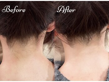 ピミル(PIMIL)/うなじ脱毛