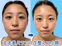 ナチュラルパーフェクトフェイス 新宿/２０才左右差・ムクミ/新宿小顔