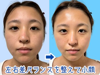 ナチュラルパーフェクトフェイス 新宿/２０才左右差・ムクミ/新宿小顔