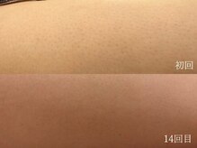 ウォーム(warm)/脱毛/顔脱毛/シェービング