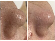 アトリエ ハルミナ(atelier harumina)/黒い毛穴汚れもすっきり☆