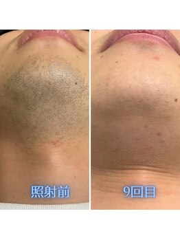 ナウザ 高崎店(NAUZA)/あご下 Before・After