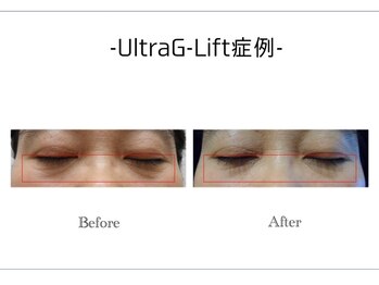 アンドエピ(&epi)/韓国痩身フェイシャル症例写真５