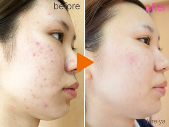 ゾーンビューティーハウス 松戸店(ZONE BEAUTY HOUSE)/ニキビケア(肌トラブルケア)