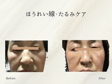 ホリスティックサロン ヘルバ(Holistic salon Herba)/ほうれい線・たるみケア施術変化