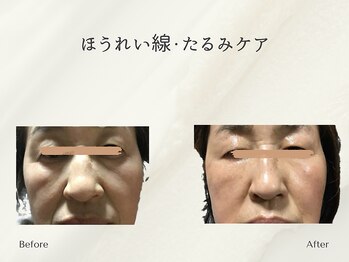 ホリスティックサロン ヘルバ(Holistic salon Herba)/ほうれい線・たるみケア施術変化