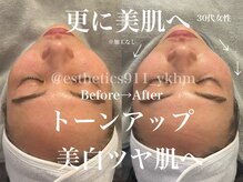 エステティックス ナインワンワン 横浜(Esthetics911) /更に美肌へ、美白ツヤ肌