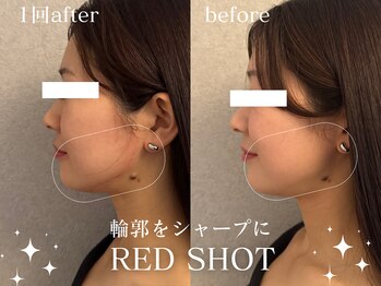 グランクウォーレ(Gran Cuore)/輪郭形成でシャープに♪