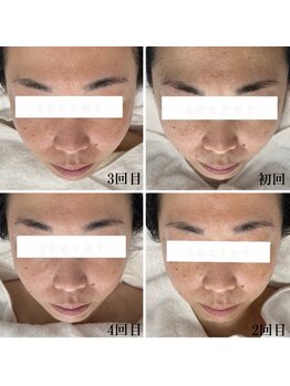 プラセル(Placer)/40代からの本気の肌質改善/札幌