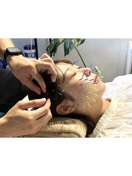 鍼灸施術を受けたい