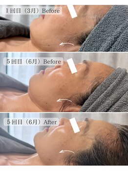 ミュアン(La Mueien)/たるみ/小顔/シワ/リフトアップ