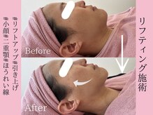 エンクリニカルラボ 京都駅前店(E&N CLINICAL LABO)/切らない糸リフト/小顔リフト