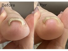 ロンディネ(Rondine)/巻き爪&ネイルトリム