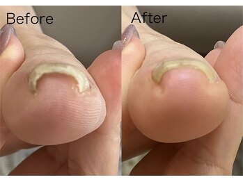 ロンディネ(Rondine)/巻き爪&ネイルトリム