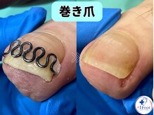 プラスワンフット 本厚木(+1 Foot)/巻き爪矯正は専門店へ●