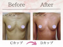 エムエムエム 表参道Luxeサロン(M.M.M)/【バストアップ例】　C→Dカップ