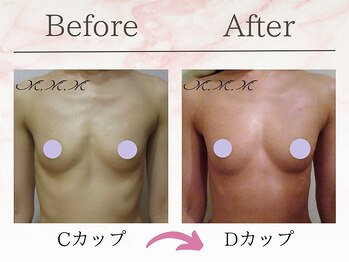 エムエムエム 表参道Luxeサロン(M.M.M)/【バストアップ例】　C→Dカップ