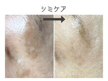 カミーシャ(KaMi-Sha)/【40代女性】シミケア症例写真