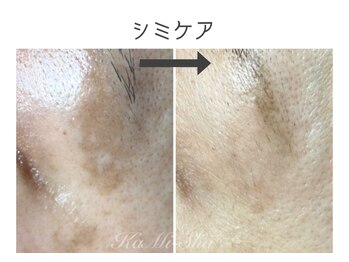 カミーシャ(KaMi-Sha)/【40代女性】シミケア症例写真