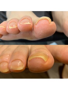 地爪ケアクリニックサロン 松江の写真/お爪の状態に合わせた施術が◎【フット《巻爪ケア（両足）》※フットバス・足裏角質ケア付き￥12,000】