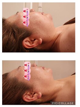 シェノン(Chainon)/セラピール×巻き肩解消