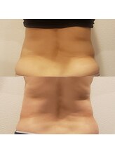 トータルエステティック ジョワイユ(JOYEUX)/お腹脂肪集中ケア