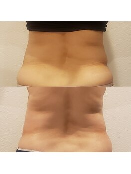トータルエステティック ジョワイユ(JOYEUX)/お腹脂肪集中ケア