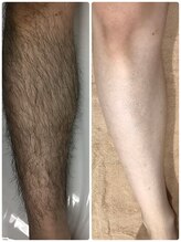 アルシスタ(ARCISTA)/【メンズ脱毛】