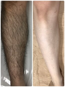 アルシスタ(ARCISTA)/【メンズ脱毛】