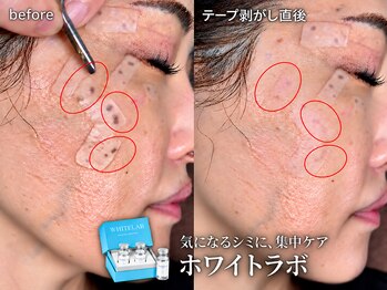 エーアール(ar)の写真/今だけ！【新メニュー★ホワイトラボ】気になるシミのお悩みに。大人のお肌に寄り添うシミケア♪