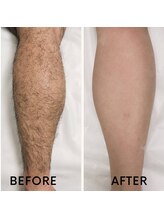 ケトリーナ/ブラジリアンワックス　ワックス