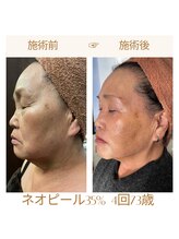 リラクゼーションサロン ラキ(laki)/ネオピール/ピーリング