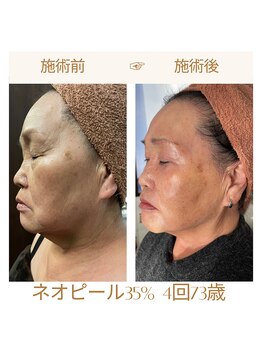 リラクゼーションサロン ラキ(laki)/ネオピール/ピーリング