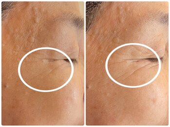 ジェイ(J)/フォト光フェイシャル