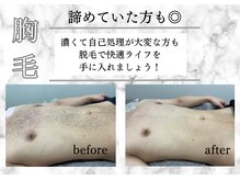 アルゴ 柳川店(ALGO)/【メンズ脱毛】ビフォーアフター