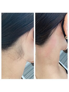 ハグ(Hug)/うなじダブル脱毛