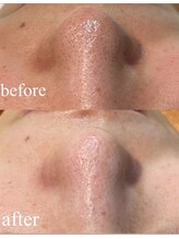 ファミーユ 太田(Fameu)/毛穴洗浄