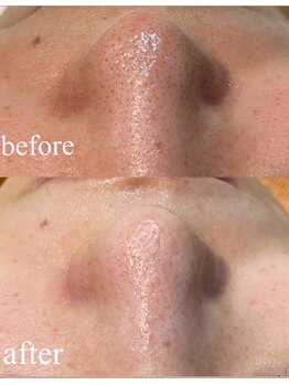 ファミーユ 太田(Fameu)/毛穴洗浄