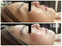 ミラン(MiLaN)/毛穴洗浄/ハイドラヴィーナス