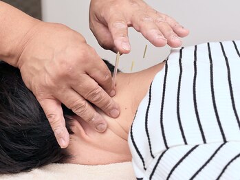 しまうら鍼灸院/首こりに鍼