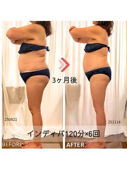 リサプリ(Re: Supple)/【脂肪燃焼】インディバボディ